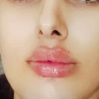 خدمات ژل و بوتاکس از ۸۵۰