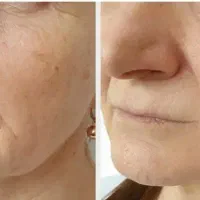 هایفو تراپی و جوانسازی پوست