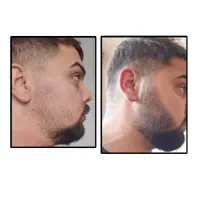 ریش با درماژن