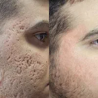 درمان (اسکار و آتروفی )