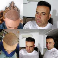 کاشت مو وابرو جشنواره ویژه