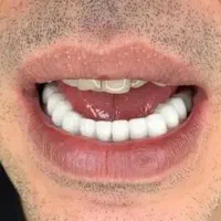 لمینت مترحک دندان|آرایشی، بهداشتی، درمانی|اهواز, آریاشهر|دیوار