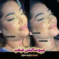 بلفاروپلاستی-سانترال لب-بوکال فت-ساکشن غبغب|خدمات آرایشگری و زیبایی|تهران, پاسداران|دیوار