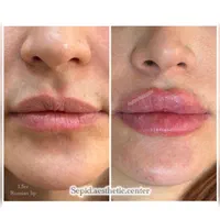 بوتاکس ژل فیلر مزو خالبرداری کرایو وهایفو ولیزر