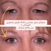 فیان صورت بدون جراحی