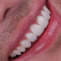 کامپوزیت دندان اقساطی بدون چک و ضامن|خدمات زیبایی و سلامت|تهران, جردن|دیوار