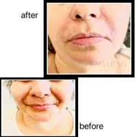 تزریق ژل و بوتاکس، نخ، مزو، فیلربادی|خدمات آرایشگری و زیبایی|ری, اقدسیه|دیوار