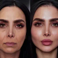 تخفیف ویژه تزریق ژل