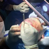 آموزش کاشت مو، مزوتراپی و پی آر پی