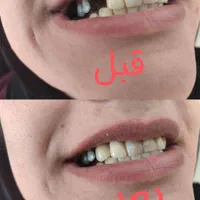 دندان مصنوعی از دم قسط|خدمات آرایشگری و زیبایی|اصفهان, شیخ طوسی|دیوار