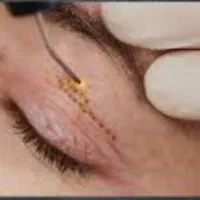 لیزر .بوتاکس ، ژل گونه و لب و چانه ،نخ و پروفایلو|خدمات زیبایی و سلامت|تهران, سلسبیل شمالی|دیوار