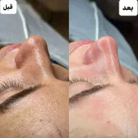 فیشیال پاکسازی تخصصی صورت