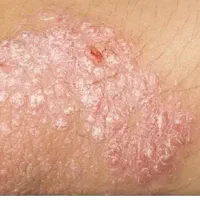 درمان پسوریازیس وصدف|آرایشی، بهداشتی، درمانی|بندر کنگان, |دیوار