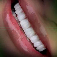 ایمپلنت کامپوزیت لمینت اقساط ویژه