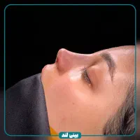 جشنواره تخفیفات جراحی بینی / عمل بینی