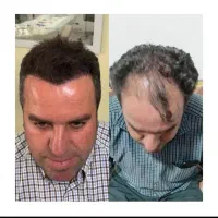 کاشت مو و ابرو شیرازی در اصفهان