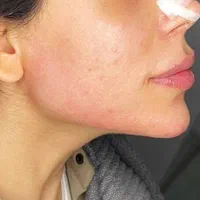 ژل لب فیلربینی مزو بوتاکس ژل بدن  ۳۹۹ آموزش پزشک|خدمات آرایشگری و زیبایی|فردیس, |دیوار