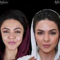 بوتاکس پیشانی و اخم ۹۹۹ژل کره ای۲/۴۰۰ توسط پزشک