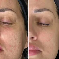 هایفو تراپی تخصصی جهت لیفت پوست