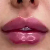 جشنواره تخفیف تزریق ژل و بوتاکس
