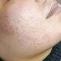 الگاپیل مزونیدلینگ