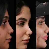 آف ویژه زیبایی بینی و لیپو ابدو