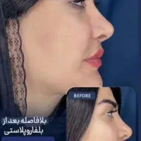 کاشت مو و ابرو ، بلفاروپلاستیک ، لیفت شقیقه و ابرو|خدمات آرایشگری و زیبایی|اهواز, نادری|دیوار