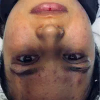 بلفاروپلاستی/کانتو پلاستی /کاشت ابرو تخفیف ویژه