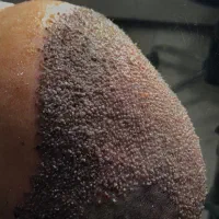 کاشت مو تخصصی در اردبیل|خدمات آرایشگری و زیبایی|اردبیل, |دیوار