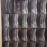 شکسته بندی اصلاح ستون فقرات