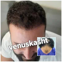 کاشت مو پر تراکم|خدمات آرایشگری و زیبایی|تهران, جردن|دیوار