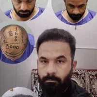 پیوند مو طبیعی با متد شیرازی