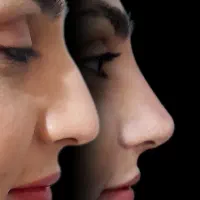 اصلاح قوزوافتادگی بینی بدون جراحی در مطب( تضمینی)|خدمات آرایشگری و زیبایی|شاهینشهر, فردوسی|دیوار