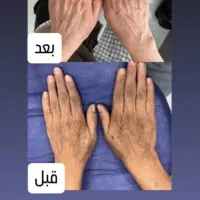 رفع تیرگی وایتنینگ و لک زیربغل و بیکینی و صورت