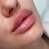 ژل فیلر بوتاکس انزیم|خدمات آرایشگری و زیبایی|خرم‌آباد, |دیوار