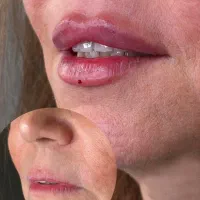 تزریق فیلر و بوتاکس با تخفیف ویژه در کلینیک زیبایی|خدمات آرایشگری و زیبایی|ساری, |دیوار