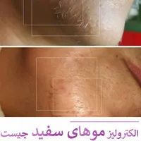 آموزش الکترولیز