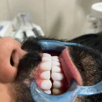 کامپوزیت دندان،عصبکشی دندان،روکش و جرمگیری