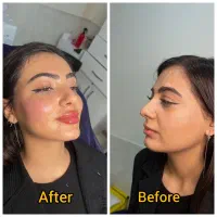 بوتاکس،فیلر،کانتورینگ