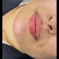 تزریق ژل وبوتاکس و آموزش فیلر با 5سال سابقه کاری|خدمات آرایشگری و زیبایی|جیرفت, |دیوار