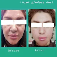 هایفو و لاغری و جوانسازی توسط پزشک متخصص|خدمات آرایشگری و زیبایی|شیراز, ارم|دیوار