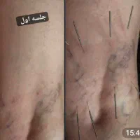 راهنمای میکنم برای واریس