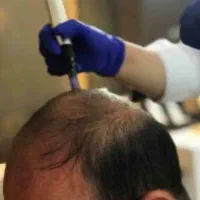 مزوتراپی مو