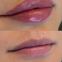 خدمات ژل و بوتاکس و مزو