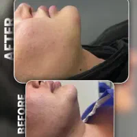 تزریق چربی .فیلر.نخ.ژل