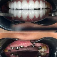 مرکز تخصصی دندانپزشکی ایمپلنت آلمانی(اقساط ۱۲ماهه)|خدمات آرایشگری و زیبایی|تبریز, |دیوار