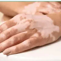 درمان انواع بیماریهای پوستی