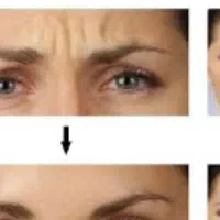 جشنواره بوتاکس ۲۹۰ لیفت شقیقه