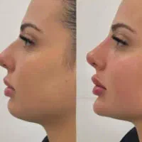 تزریق ژل و بوتاکس بصورت نقد و اقساط|خدمات آرایشگری و زیبایی|فولادشهر, ورزشگاه فولادشهر|دیوار