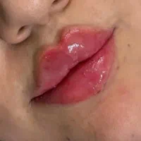 خدمات ژل و بوتاکس با پترو و آزاد